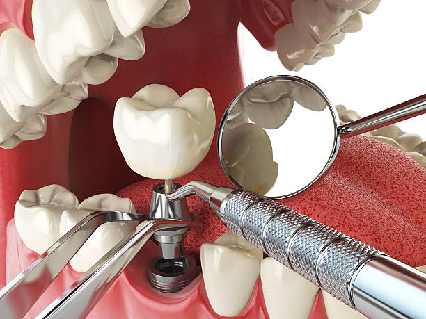 Best Lost Filling or Crown Replacement in Horse Shoe, NC